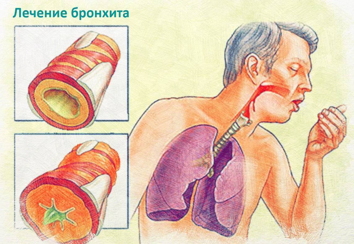 Кашель верхних дыхательных путей: каковы причины и лечение