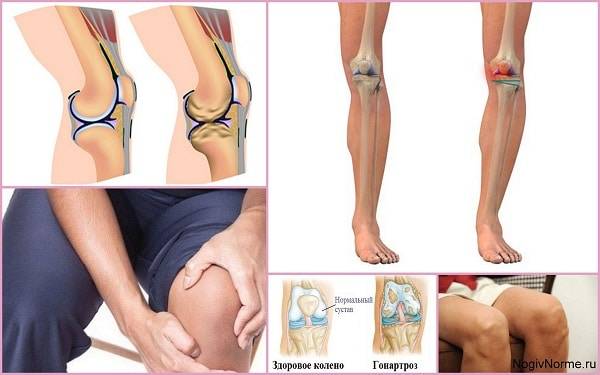 Артроз коленного сустава : |симптомы | препараты | уколы внутримышечно