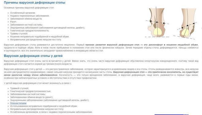 Лечение вальгусной деформации ortoped-klinik.com
