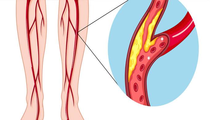 Заболевание периферических артерий и вен: тромбозы, варикоз, аневризмы