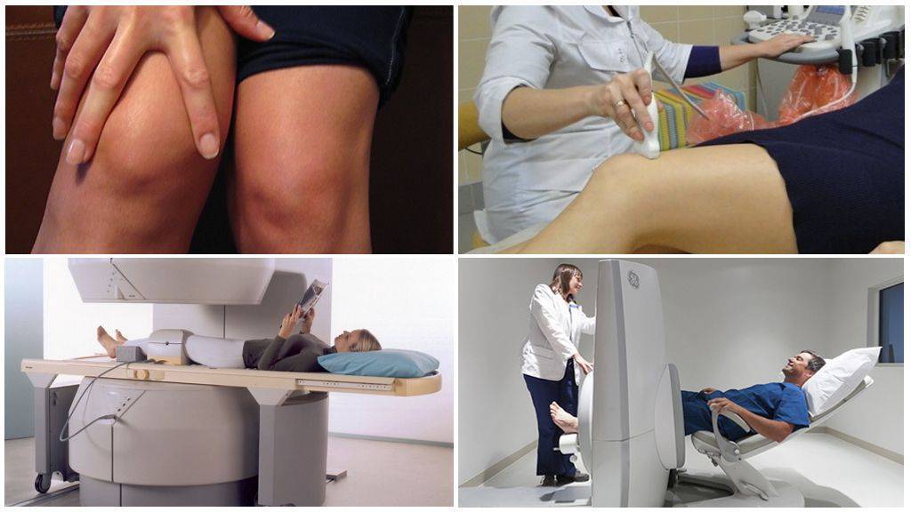 Артроз коленного сустава: симптомы и лечение | артрадол