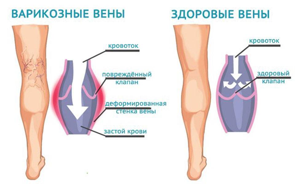 Массаж ног при варикозе — можно ли делать