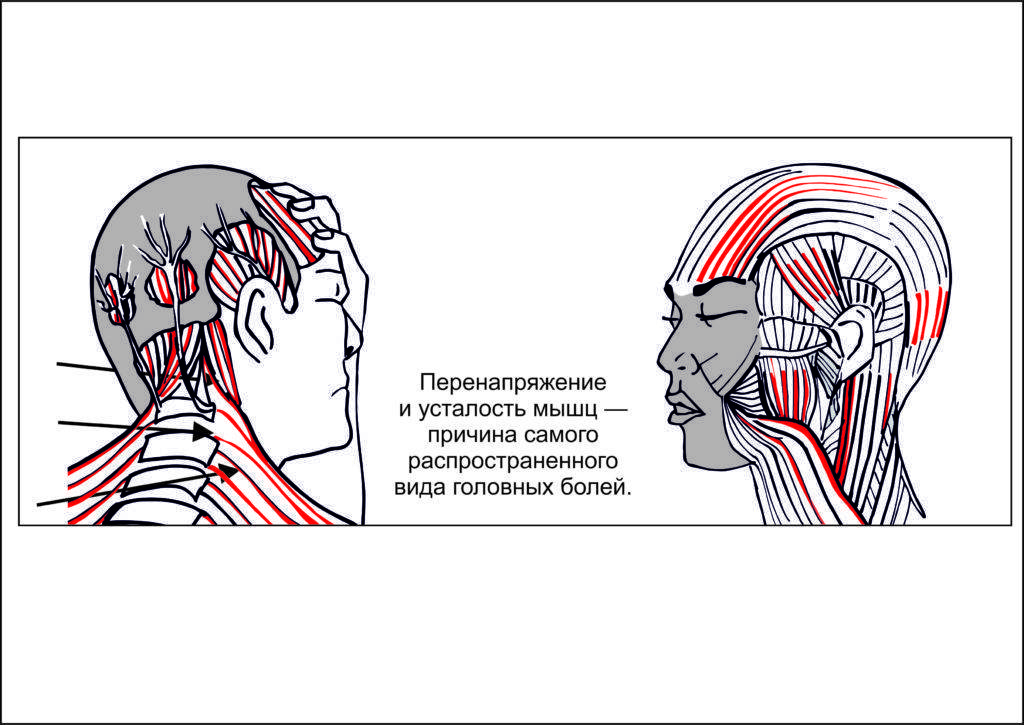 Есть ли у вас перенапряжение мышц: проверьте