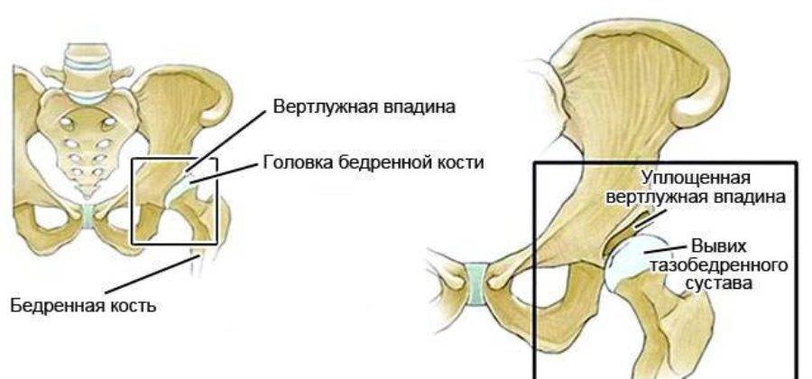 Врожденные ортопедические деформации; дисплазия тазобедренного сустава | eurolab | травматология